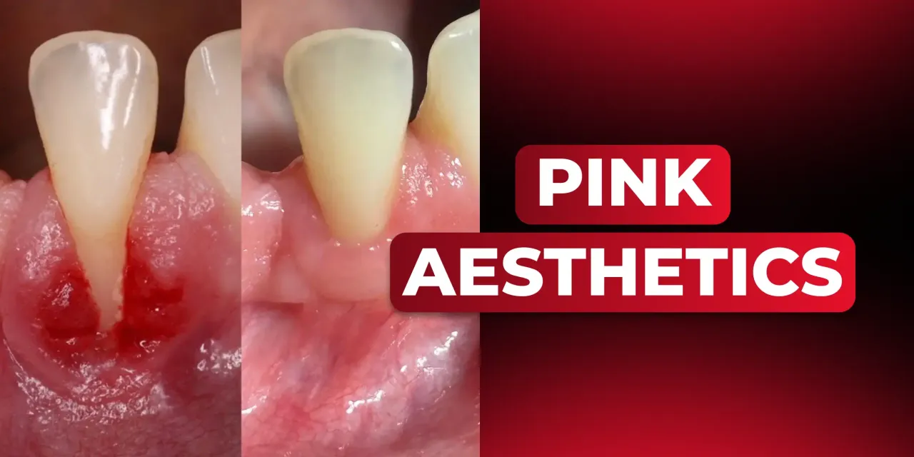OHI-S Pink Aesthetics, Recession and Gingival Smile Treatment