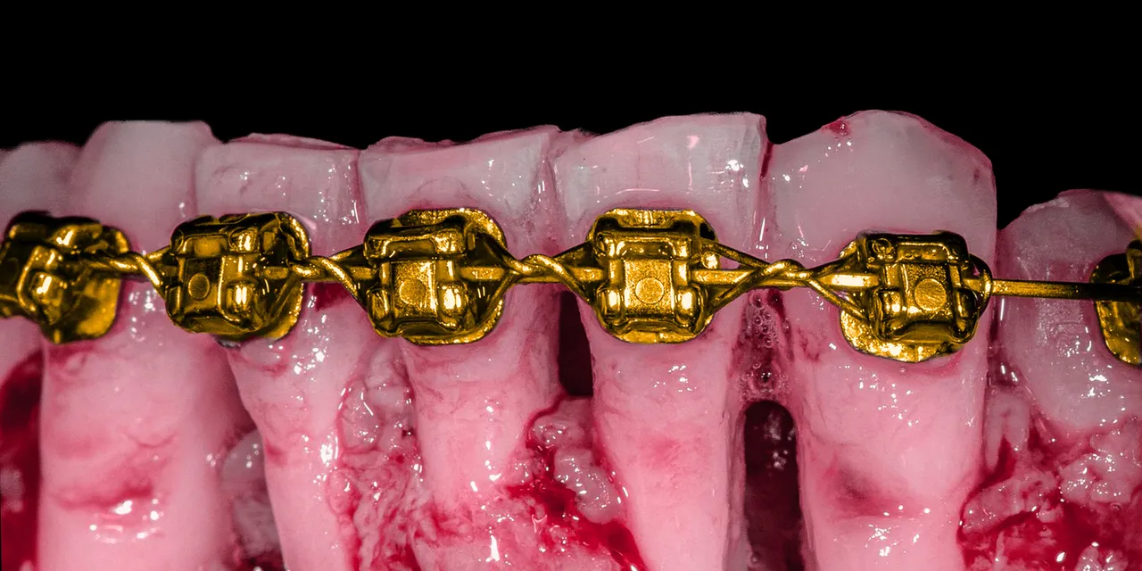 Orthodontic corticotomy. The clinical use of corticotomy and guided bone regeneration