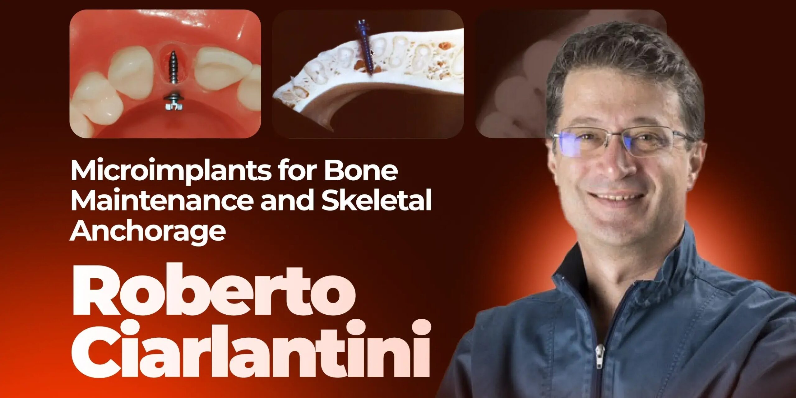 OHI-S Microimplants as Bone Maintainers and Skeletal Anchorage Insertion Protocols