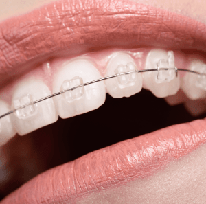 Self-Litigating Ceramic Braces - Dr Amanda Koh