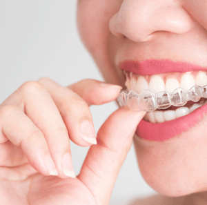 Invisible Braces - Dr Amanda Koh
