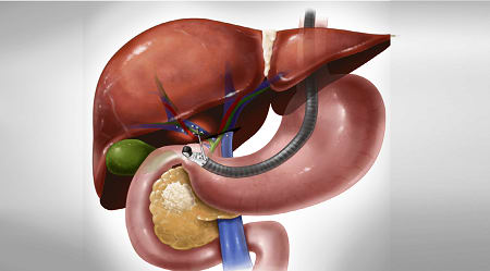 Pancreatobiliary