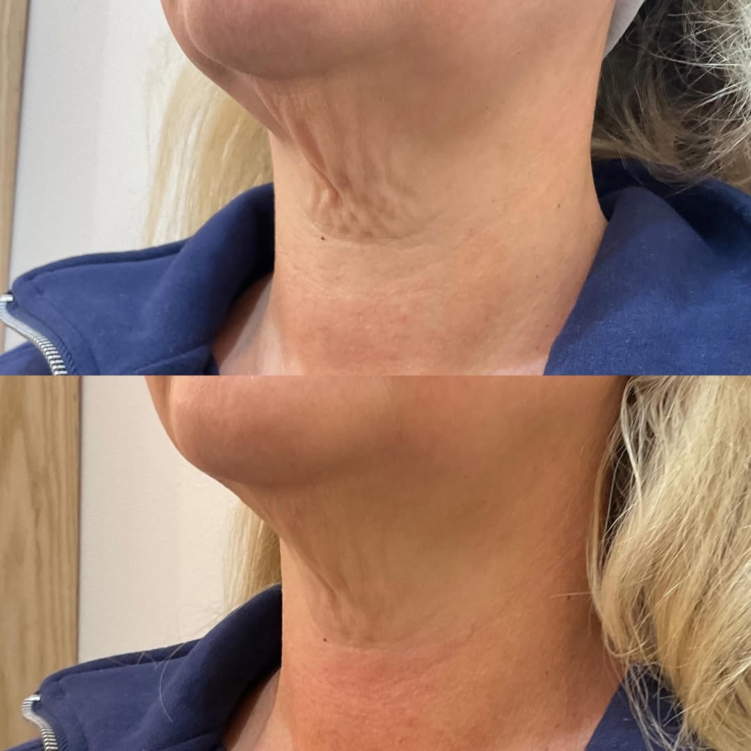 Resultados Thermage