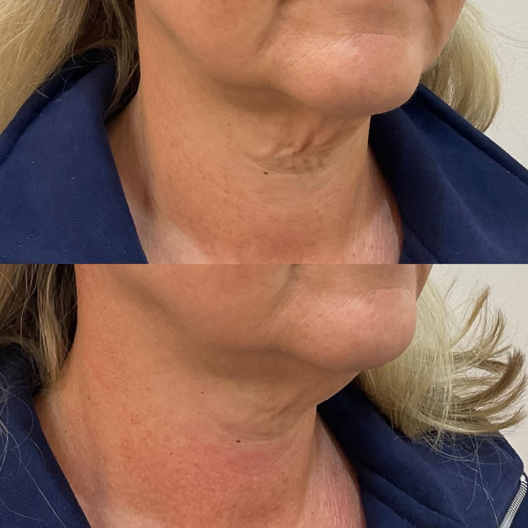 Resultados Thermage
