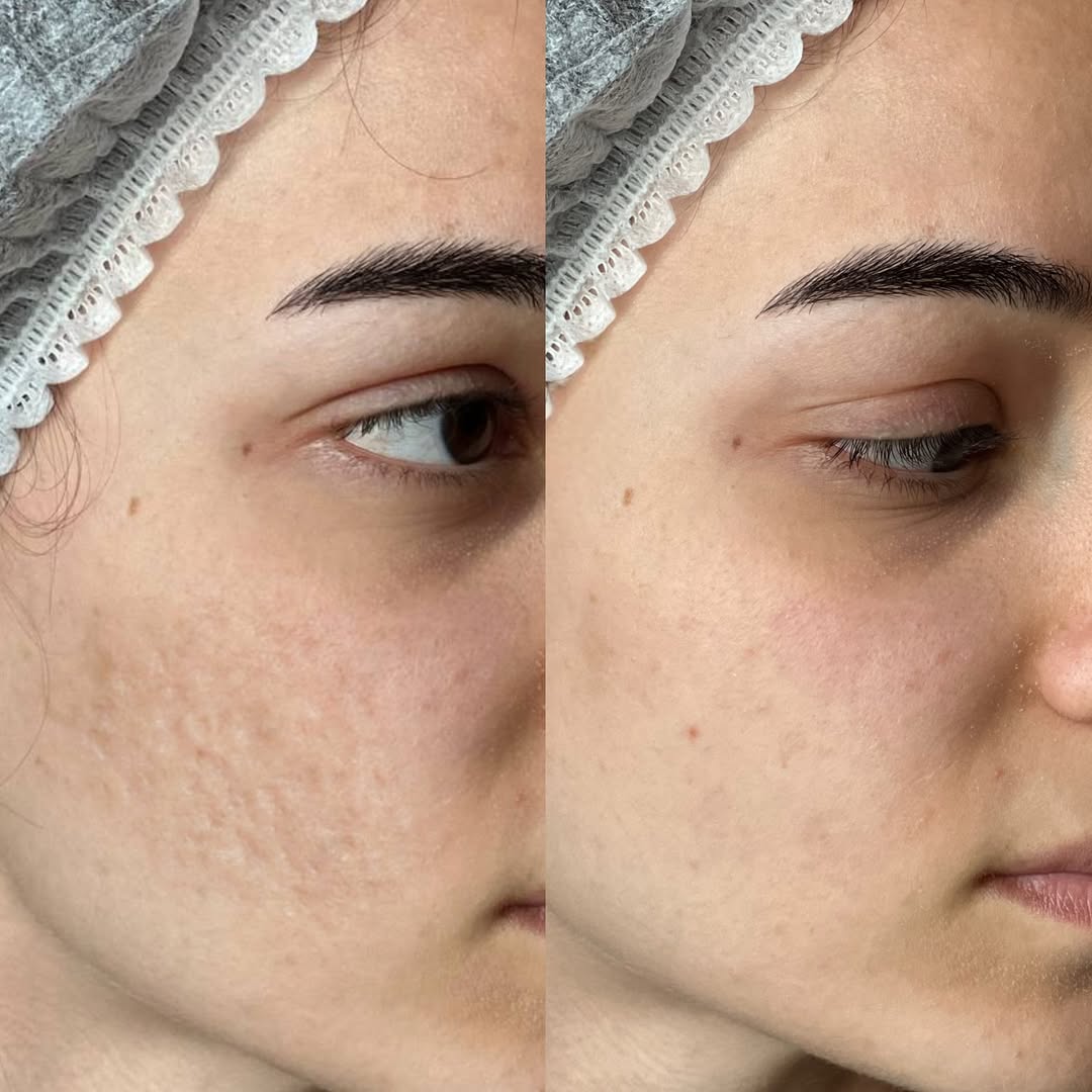 Antes y después · Morpheus 8