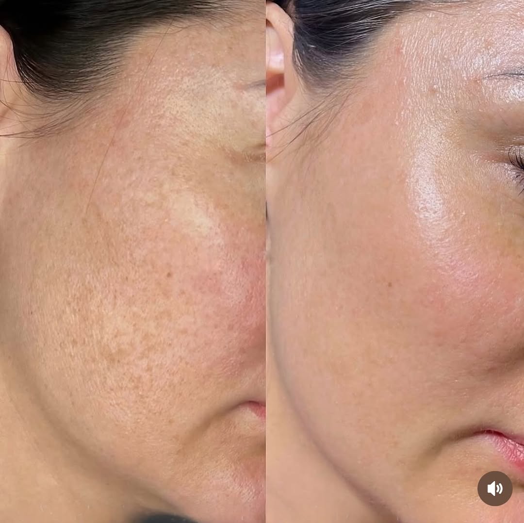 Antes y después · Dermapen