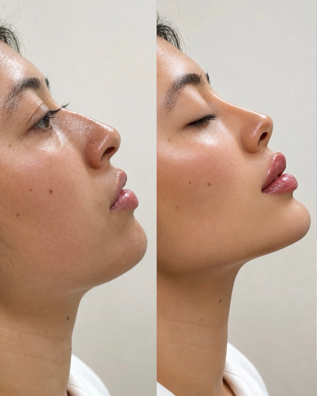 Antes y después · Aumento de labios