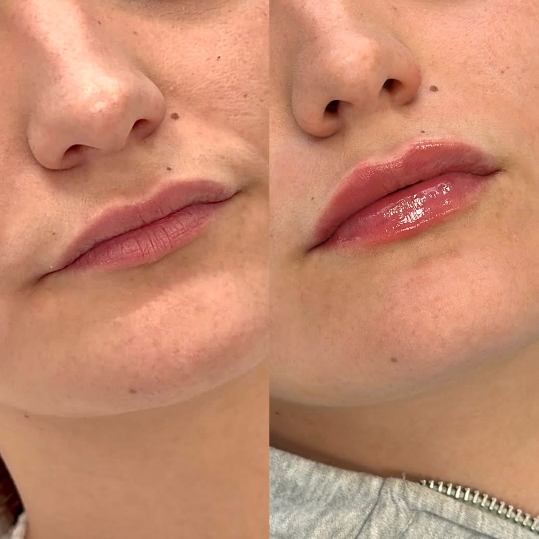 Antes y después · Aumento de labios