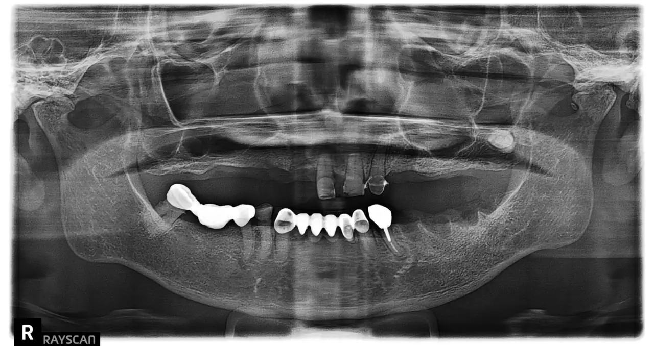 Implant Before.webp