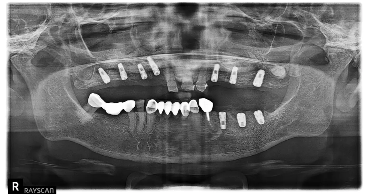 Implant After.webp