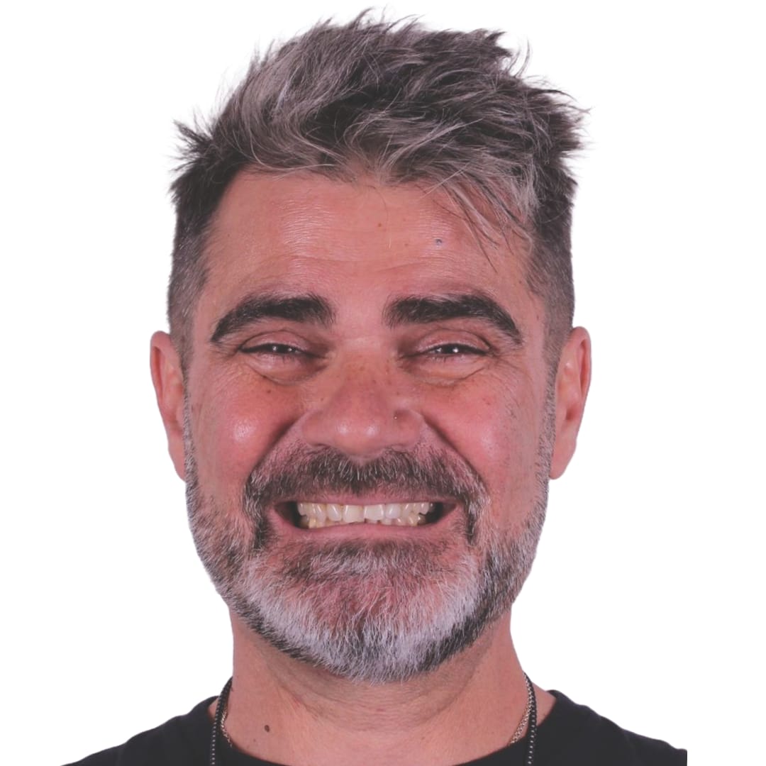 Dientes desgastados y amarillentos por bruxismo — antes — rostro frontal — Dr. Ariel Merino AM Estética Dental Puerto Madero