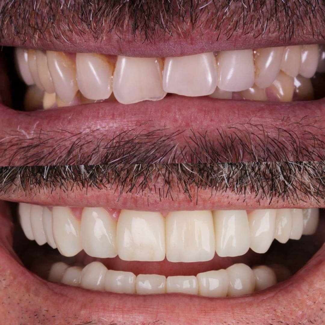 Bruxismo boca entreabierta labios antes y después — carillas cerámicas — Dr. Ariel Merino AM Estética Dental Puerto Madero