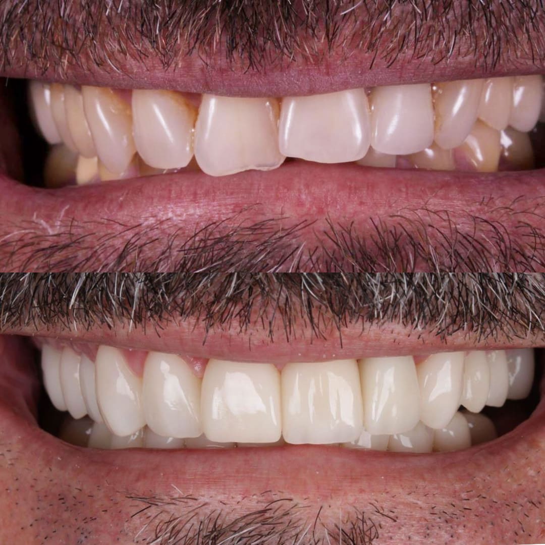 Bruxismo labios y sonrisa antes y después — carillas cerámicas rejuvenecimiento dental — Dr. Ariel Merino AM Estética Dental