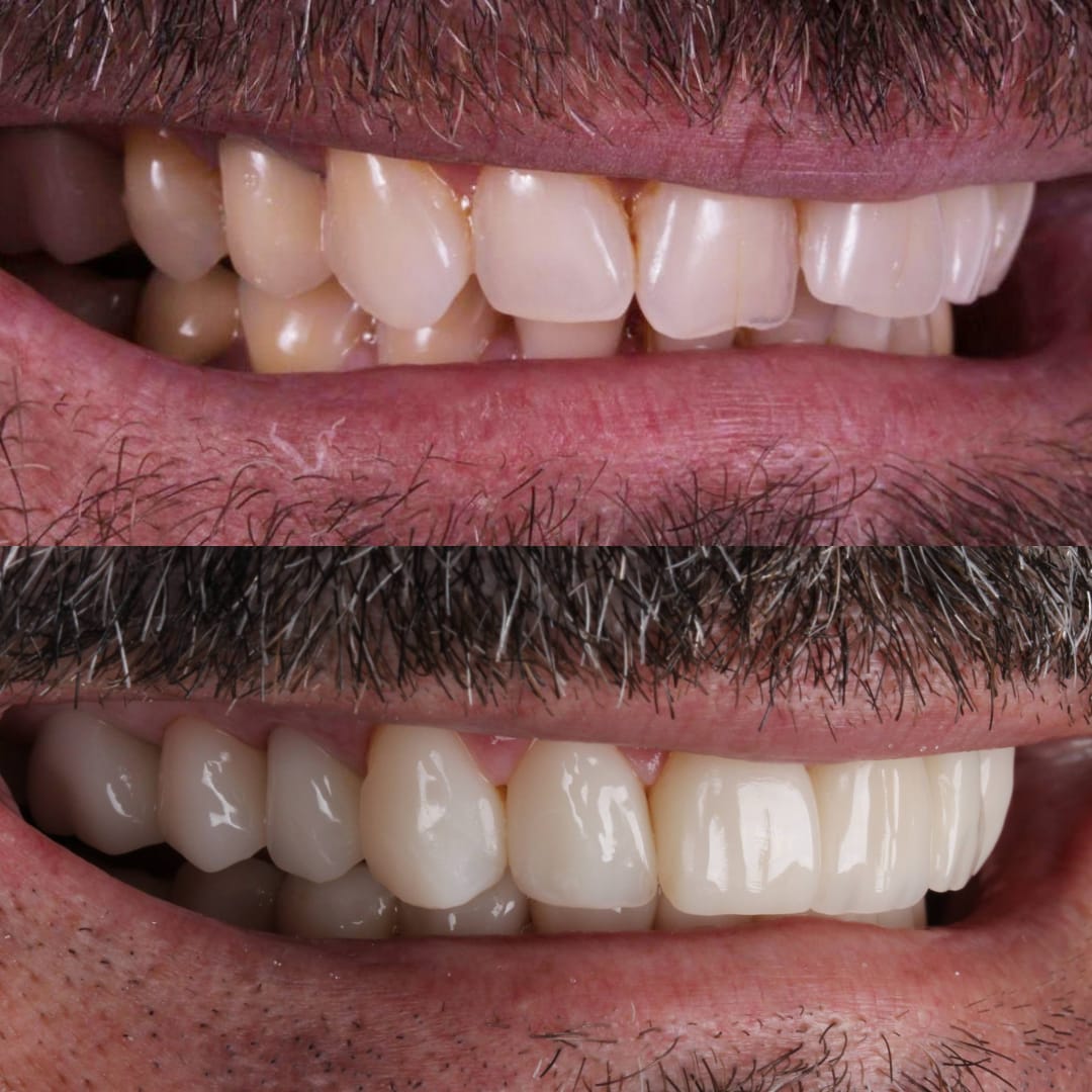 Bruxismo perfil antes y después rehabilitación cerámica carillas — Dr. Ariel Merino AM Estética Dental Buenos Aires