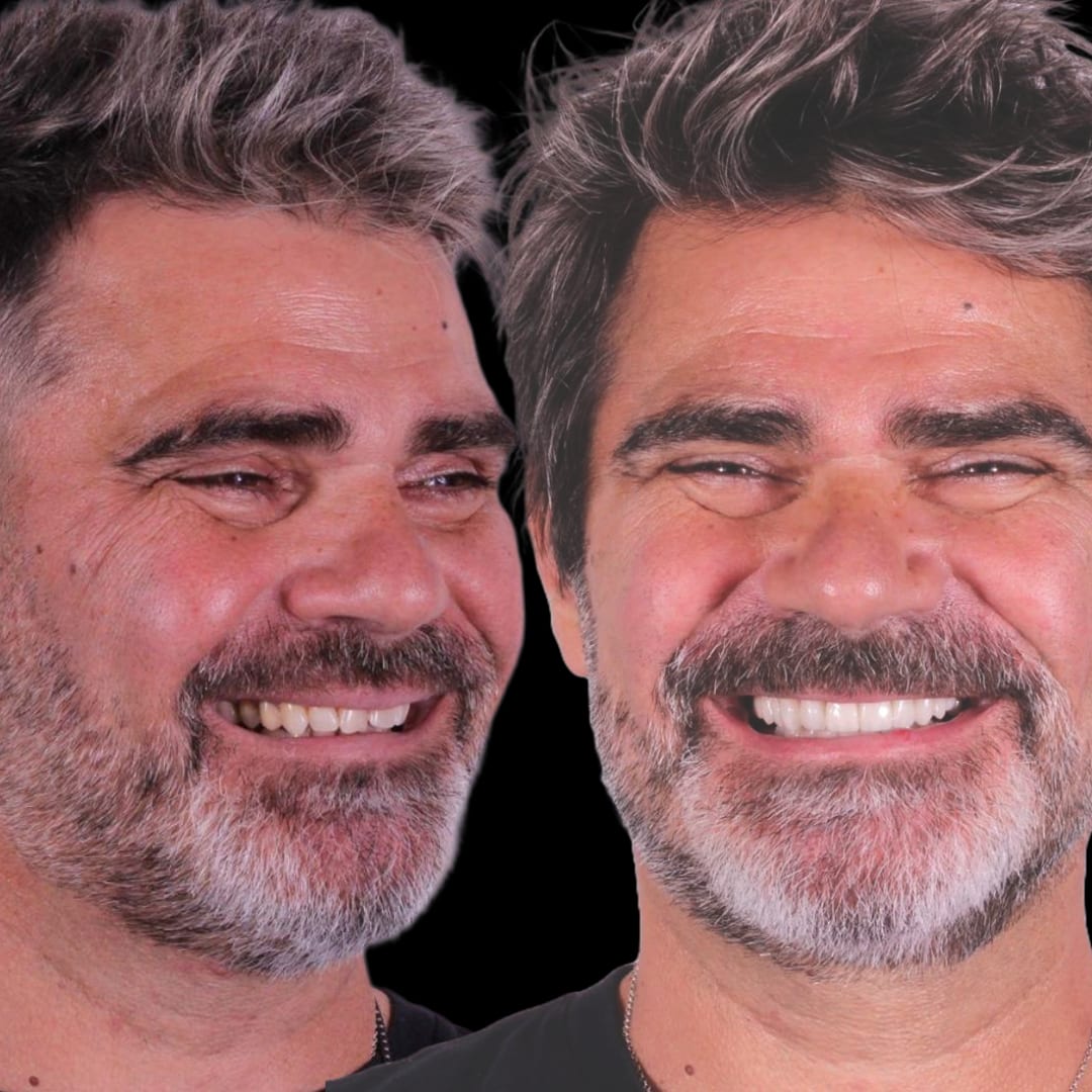Bruxismo rostro perfil comparativa antes y después carillas cerámicas — Dr. Ariel Merino AM Estética Dental Puerto Madero
