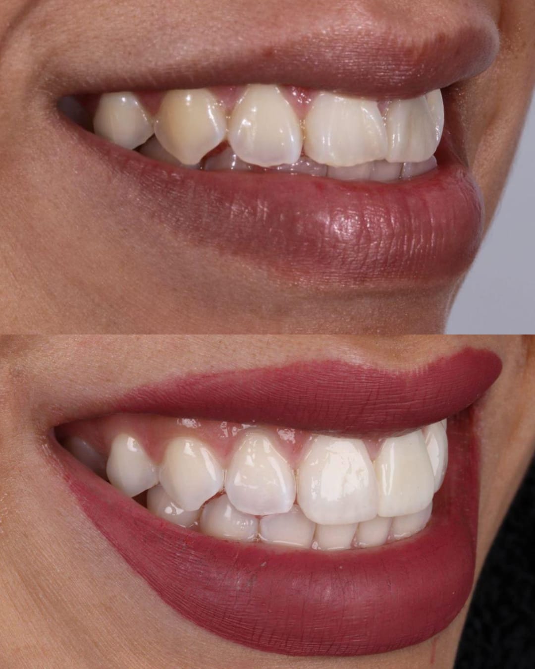 Antes y después de carilla unitaria en incisivo central vista de perfil derecho — AM Estética Dental Buenos Aires