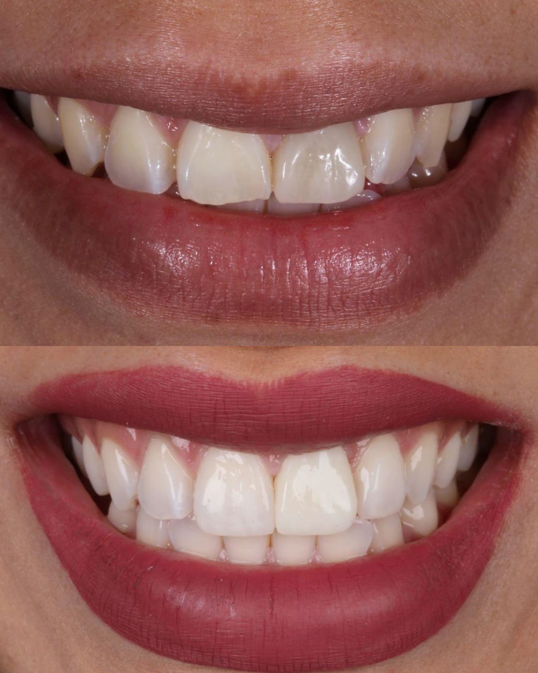 Resultado natural de carilla cerámica unitaria en incisivo central oscurecido — Dr. Ariel Merino AM Estética Dental Puerto Madero