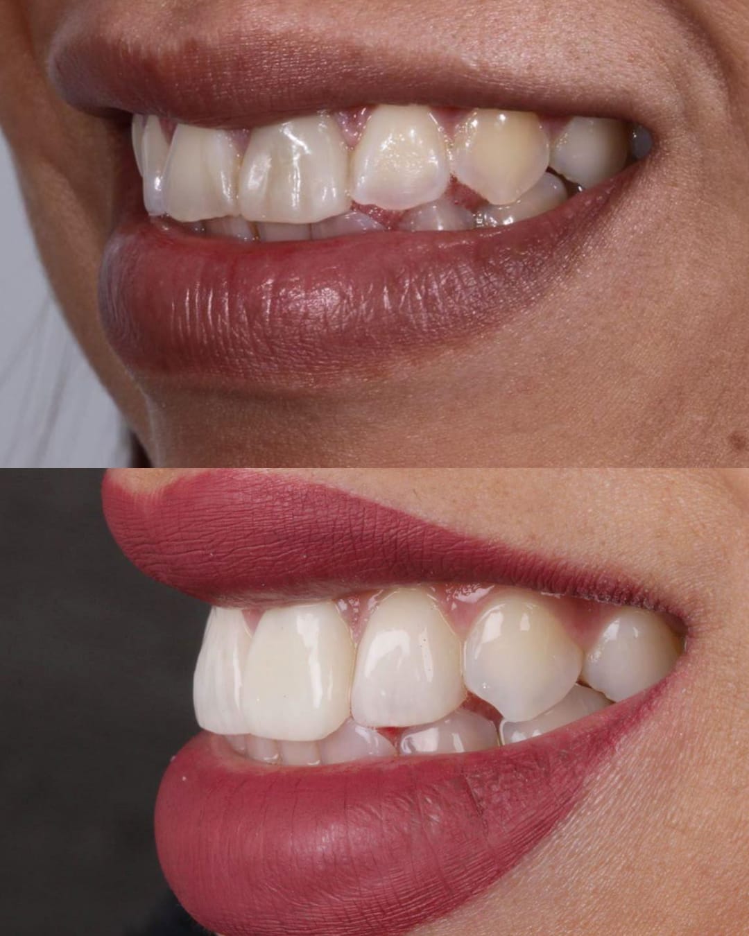 Comparativa con labios de carilla unitaria en incisivo central y armonización con resinas y blanqueamiento — AM Estética Dental