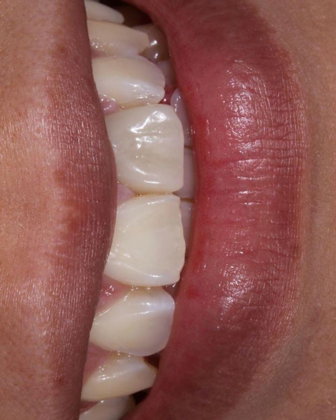 Antes y después de carilla unitaria en incisivo central oscurecido por traumatismo infantil — Dr. Ariel Merino AM Estética Dental Puerto Madero