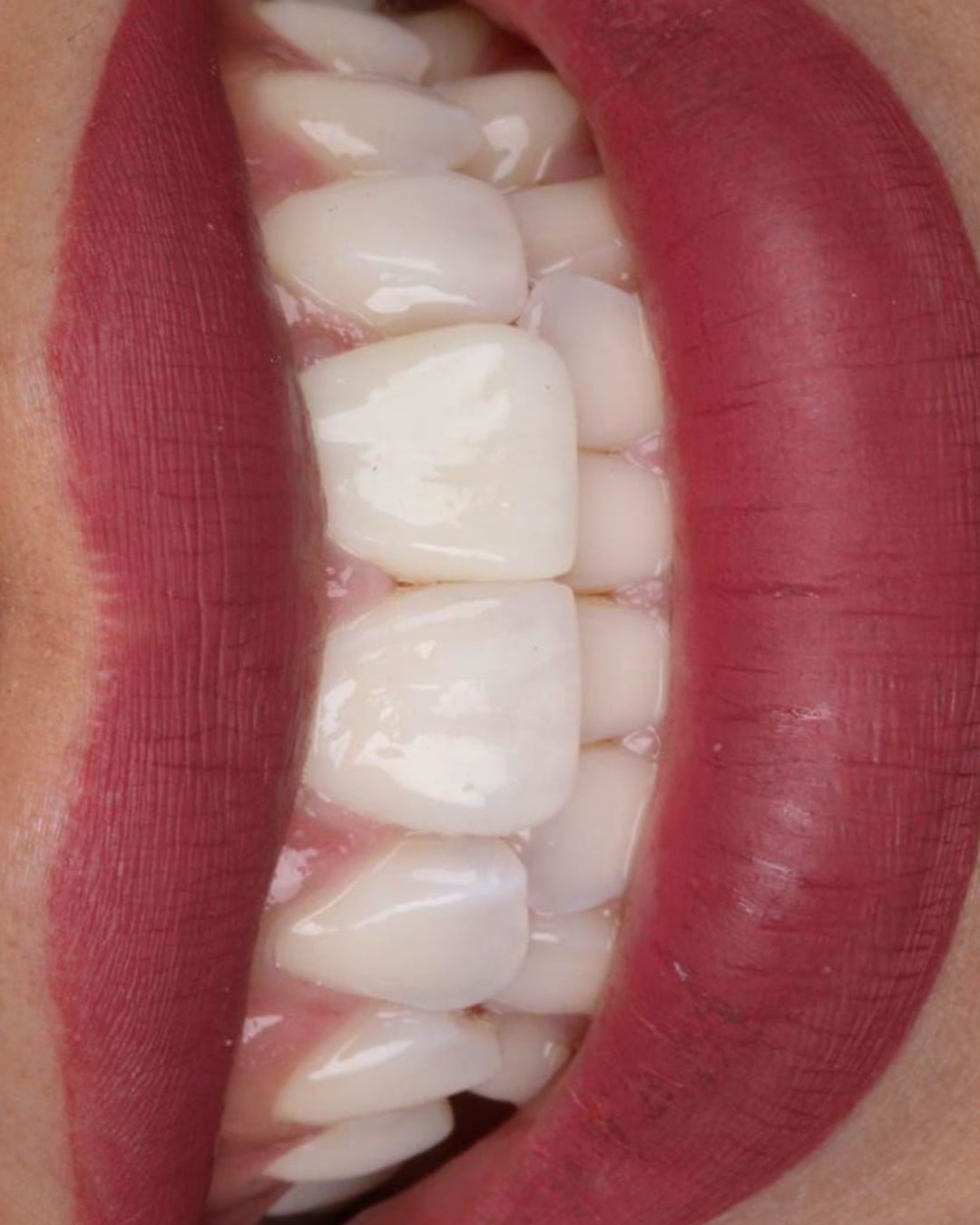Foto inicial de incisivo central oscurecido antes de carilla unitaria cerámica — AM Estética Dental Puerto Madero
