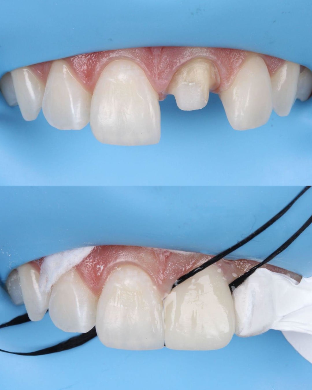 Proceso de cementado adhesivo de carilla unitaria en incisivo central — AM Estética Dental Puerto Madero