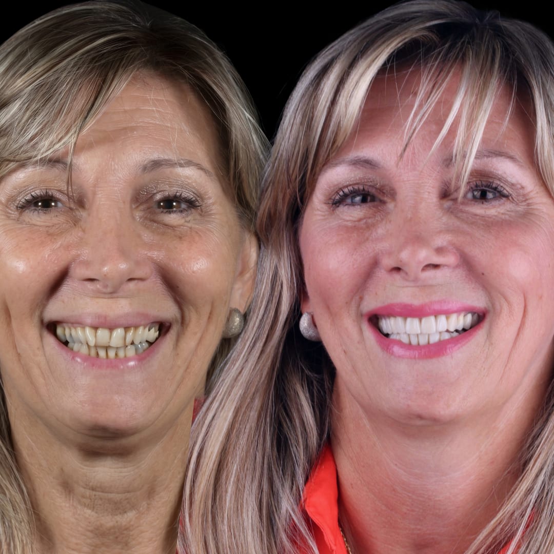 Antes y después facial de rehabilitación cerámica en ambos maxilares sin cirugía ni ortodoncia, con más de 13 años de seguimiento — Dr. Ariel Merino, AM Estética Dental