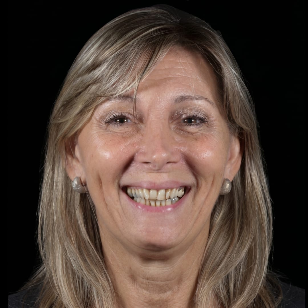Estado inicial de paciente con apiñamiento dentario antes de una rehabilitación cerámica sin cirugía ni ortodoncia