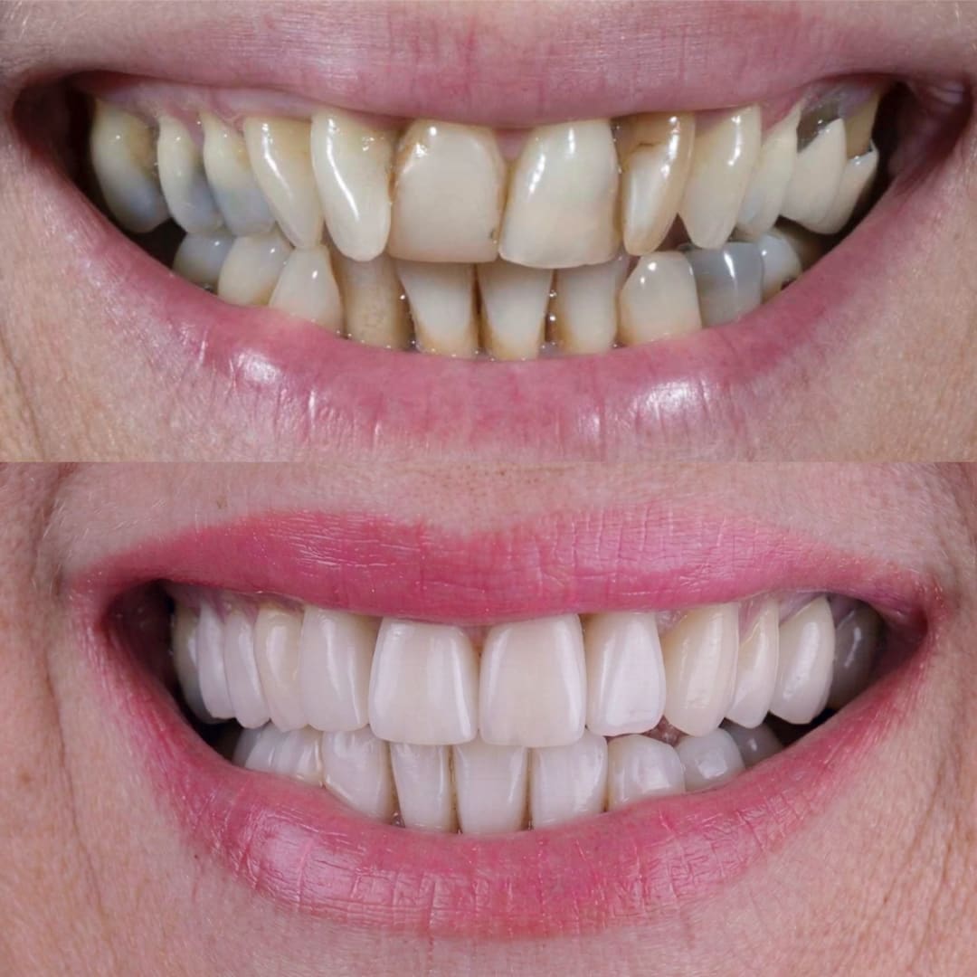 Comparación de sonrisa antes y después de rehabilitación cerámica en ambos maxilares sin ortodoncia