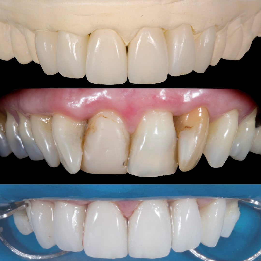 Secuencia clínica de diseño de sonrisa y rehabilitación oral con cerámicas en ambos maxilares