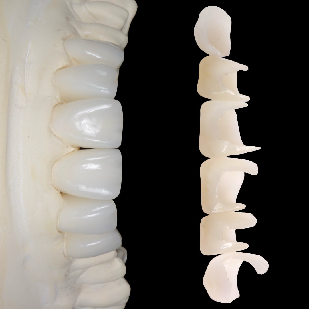 Modelo dental y restauraciones cerámicas utilizadas en la rehabilitación estética de ambos maxilares