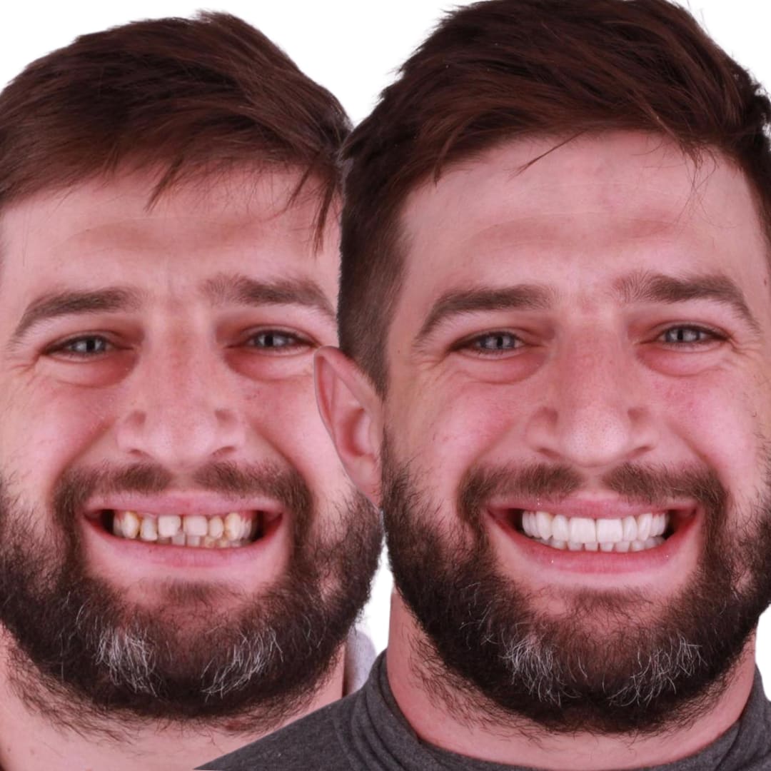 Caries y resinas viejas — carillas de resina nueva y gingivectomía láser — antes y después comparativa rostro — Dr. Ariel Merino AM Estética Dental Buenos Aires