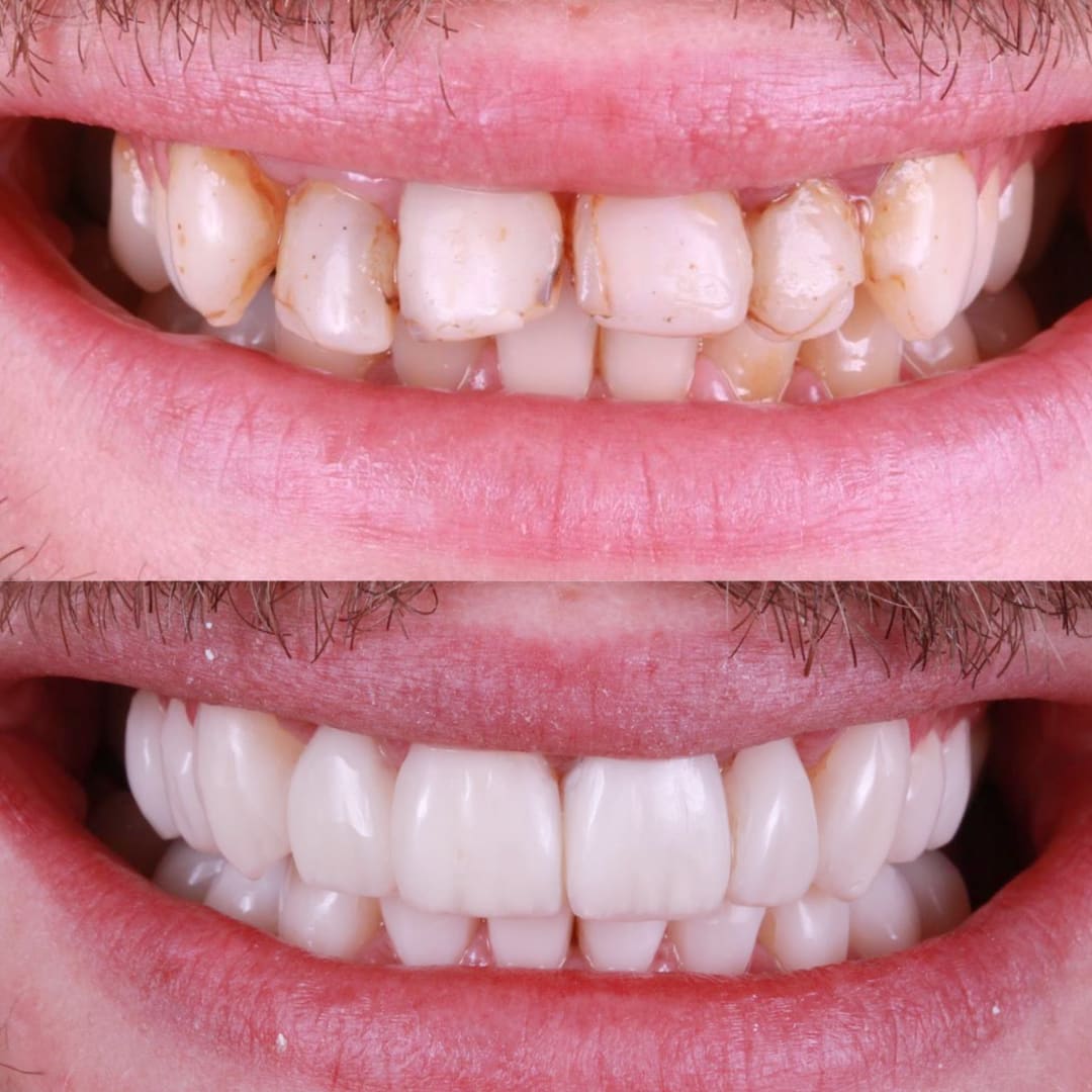 Carillas de resina sobre caries y resinas viejas — labios antes y después — Dr. Ariel Merino AM Estética Dental Puerto Madero Buenos Aires