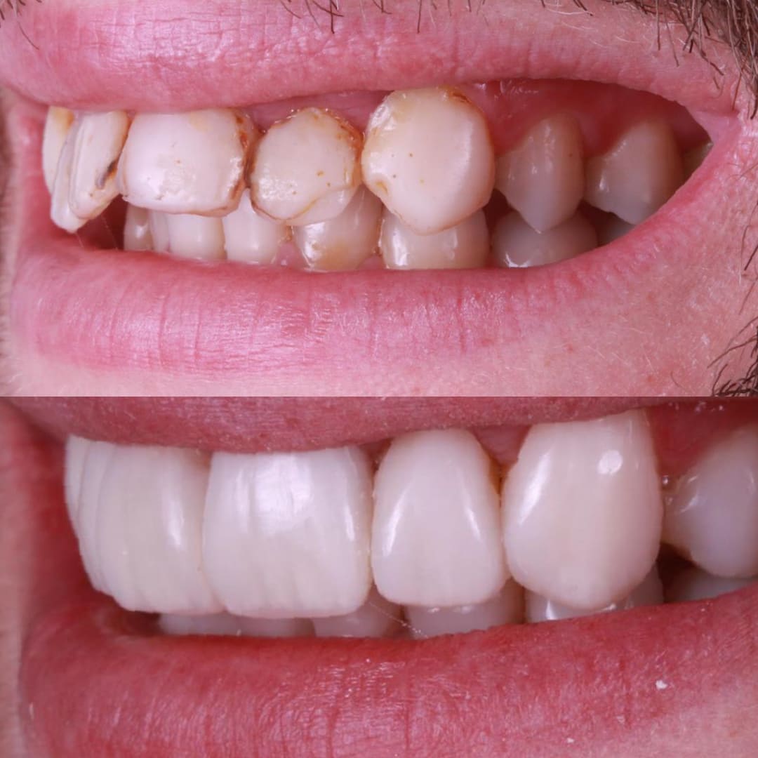 Diseño de sonrisa en resina labios perfil antes y después gingivectomía láser — Dr. Ariel Merino AM Estética Dental Buenos Aires