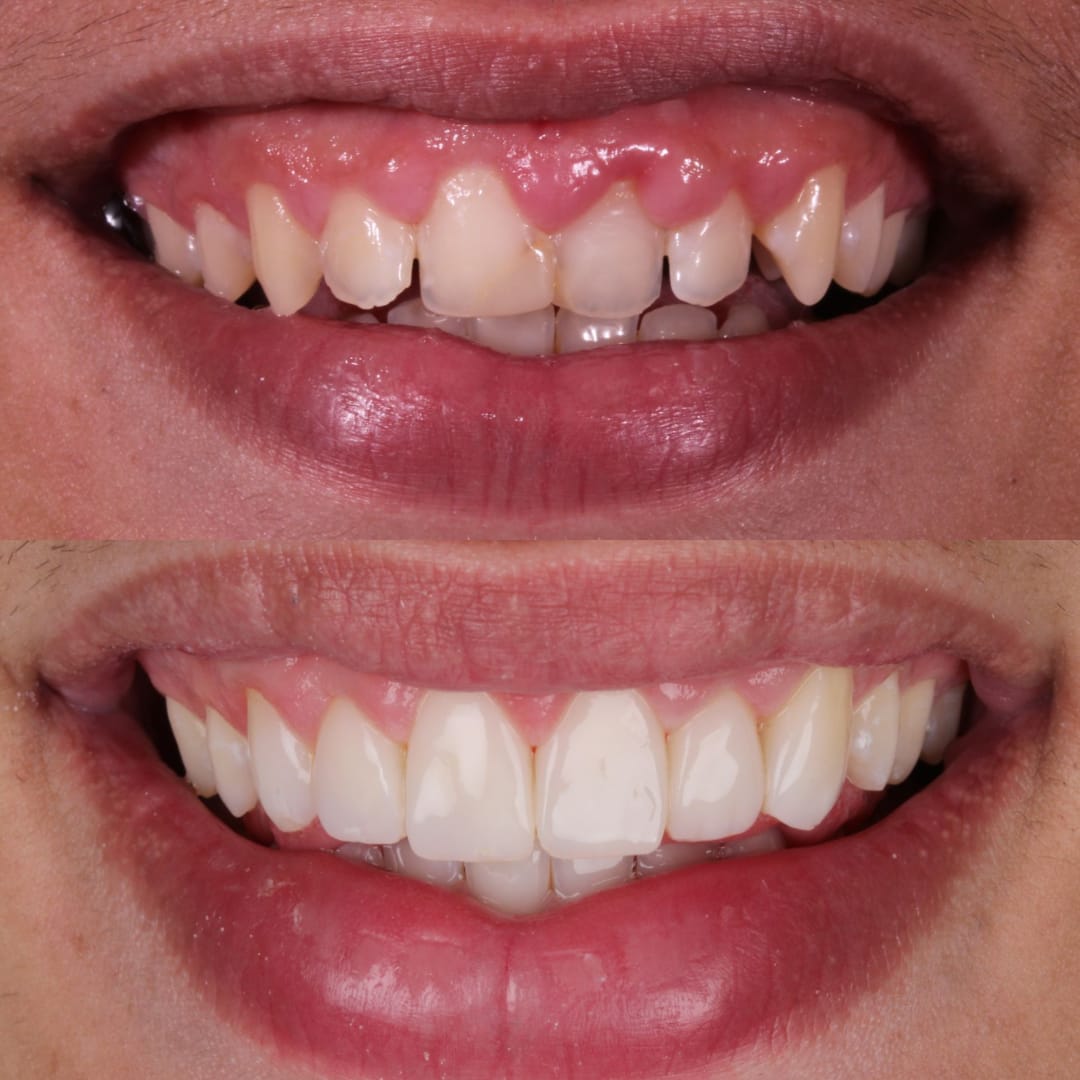 Carillas de resina labios antes y después diseño de sonrisa — Dr. Ariel Merino AM Estética Dental Buenos Aires