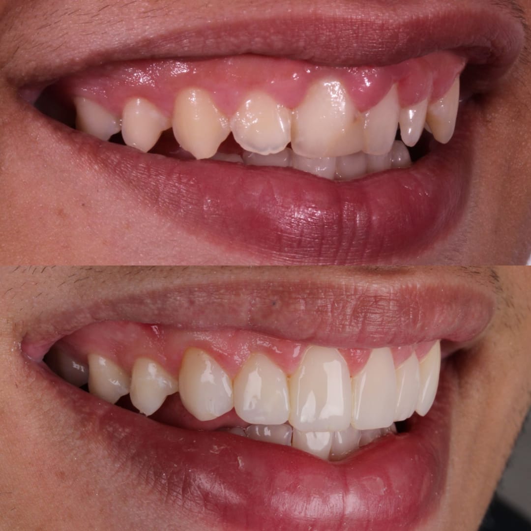 Carillas de resina labios perfil antes y después — Dr. Ariel Merino AM Estética Dental Puerto Madero Buenos Aires