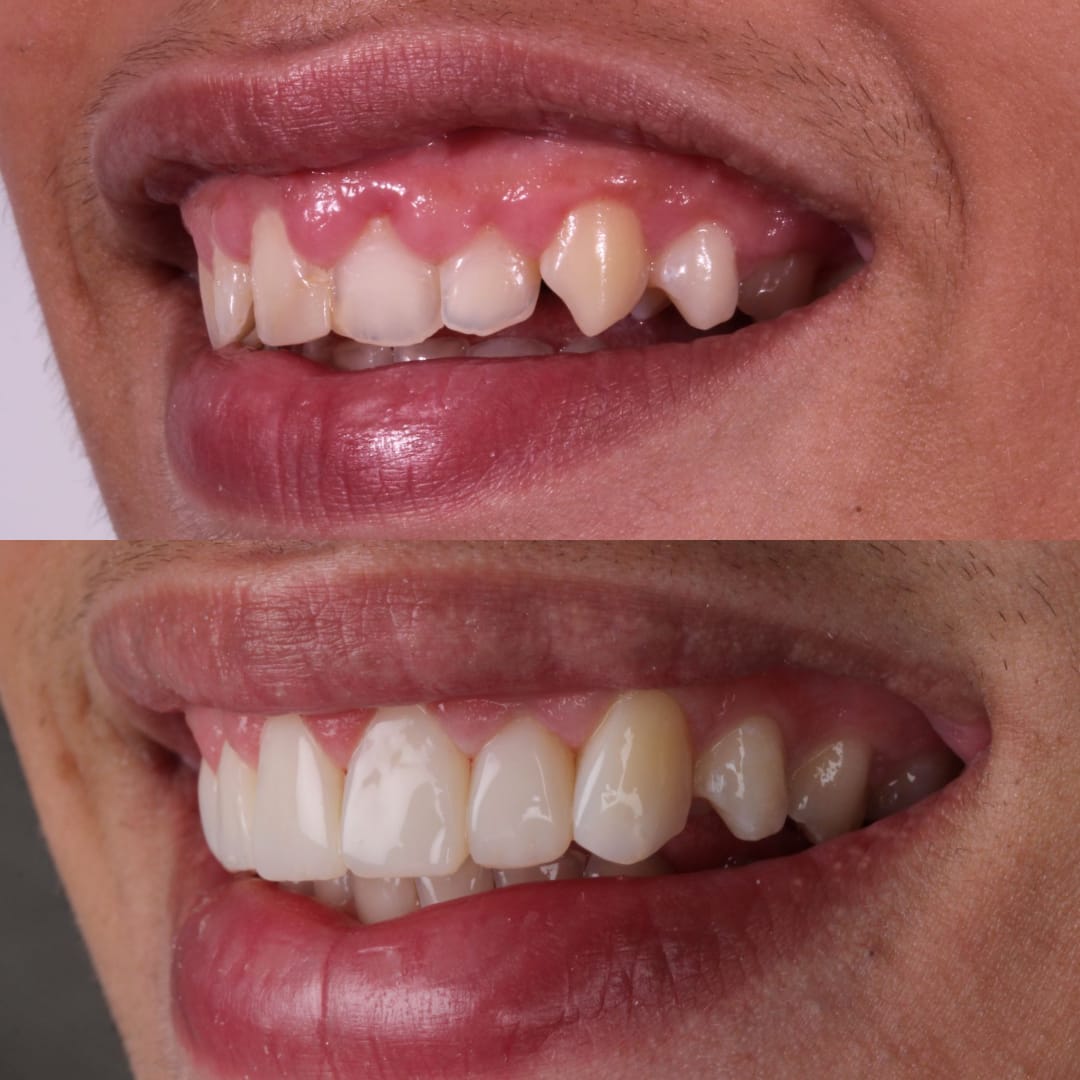 Carillas de resina resultado labios perfil — Dr. Ariel Merino AM Estética Dental Buenos Aires