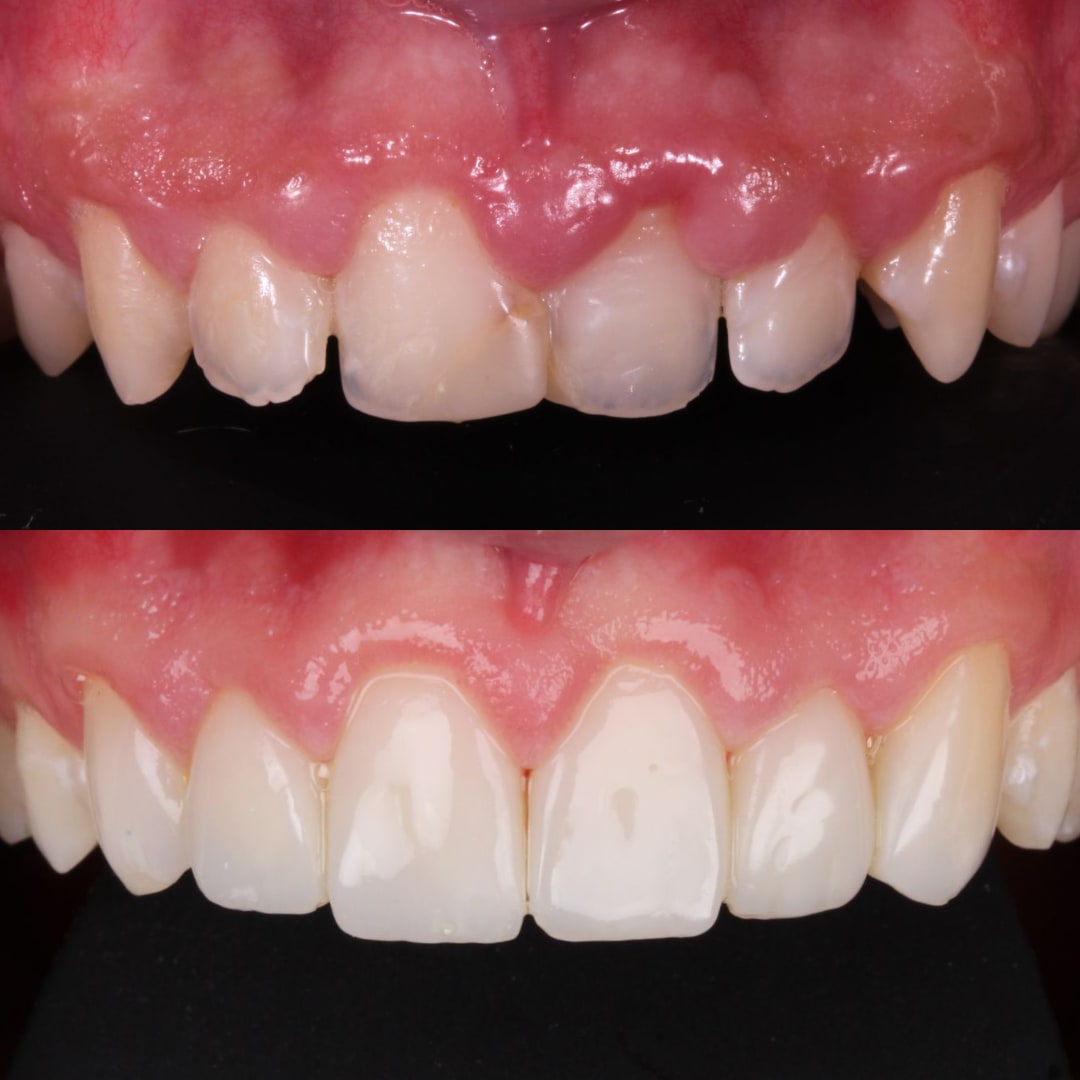 Gingivectomía láser y carillas de resina antes y después diseño de sonrisa — Dr. Ariel Merino AM Estética Dental Buenos Aires