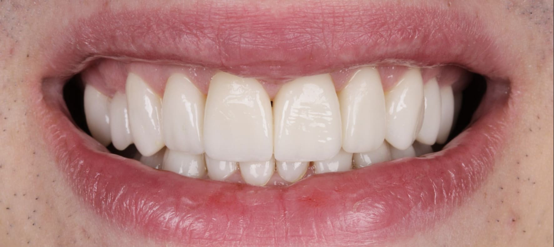 Resultado natural con lentes de contacto dental y carillas — AM Estética Dental Buenos Aires