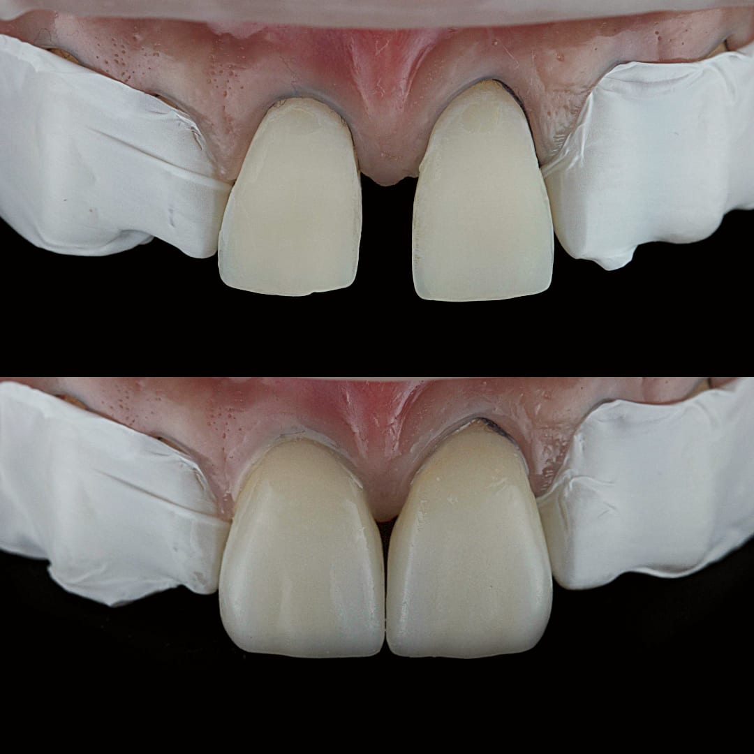 Cementado de carillas cerámicas cada dos dientes — diseño de sonrisa — Dr. Ariel Merino AM Estética Dental Buenos Aires