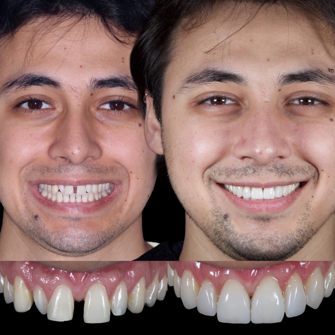 Diseño de sonrisa dientes conoidos — antes y después rostro e intraoral — Dr. Ariel Merino AM Estética Dental Buenos Aires