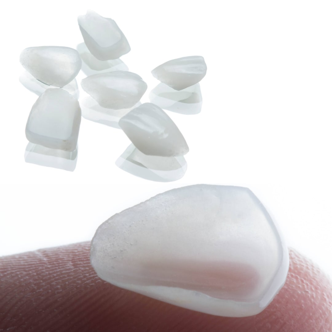 Fragmentos cerámicos carillas AM diseño de sonrisa — Dr. Ariel Merino AM Estética Dental Puerto Madero