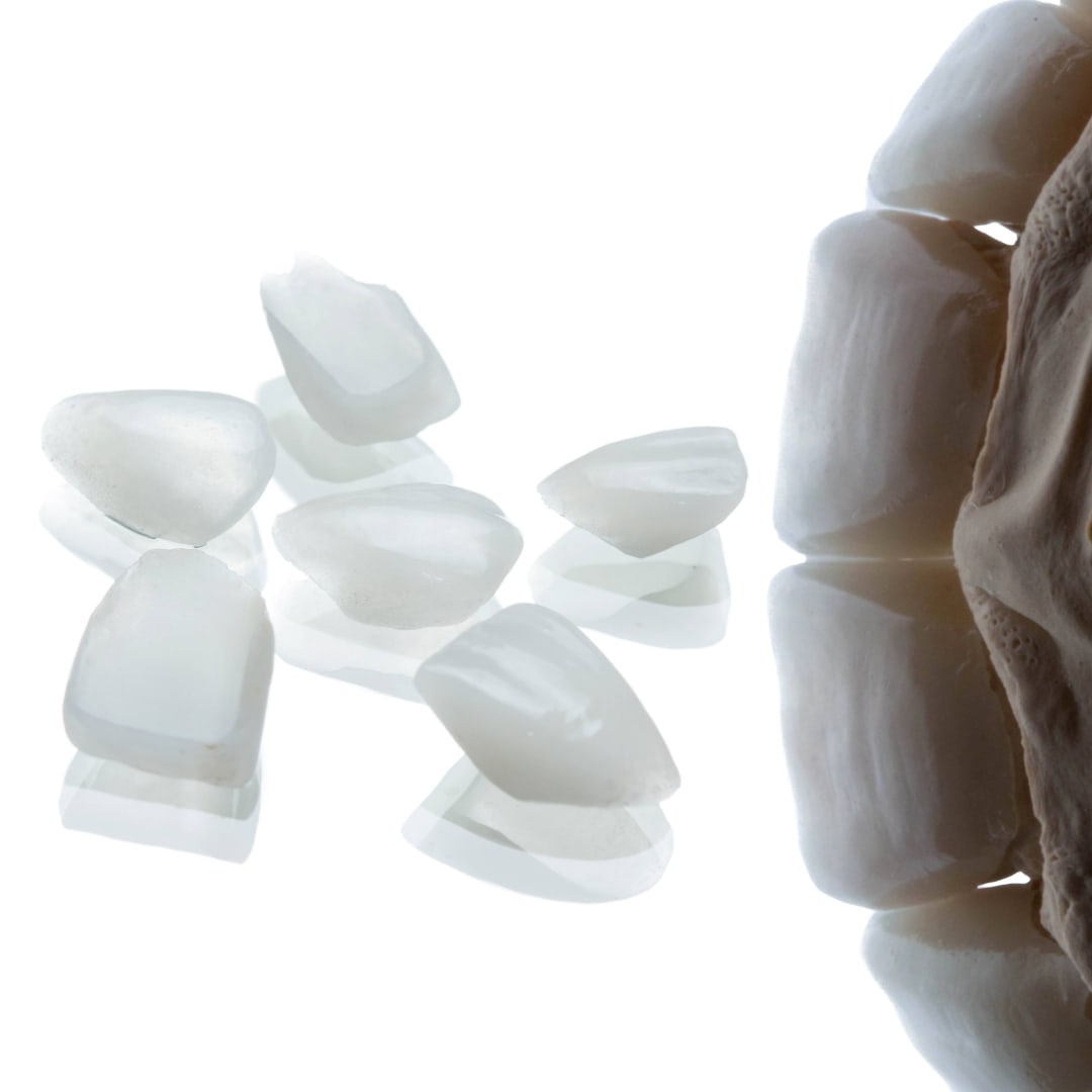 Fragmentos cerámicos lentes de contacto dental 0.2-0.3mm — carillas AM ultra delgadas — Dr. Ariel Merino AM Estética Dental Buenos Aires