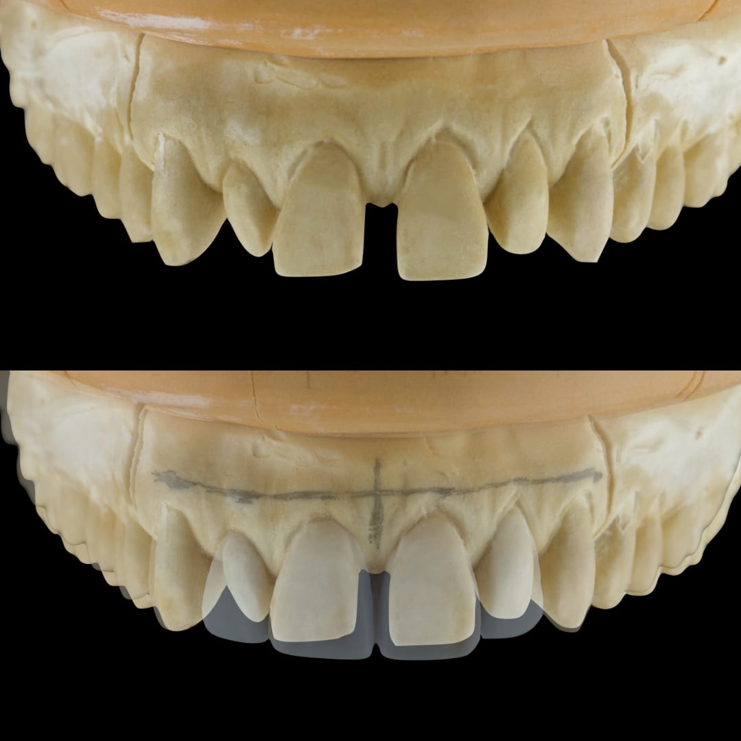 Modelos de yeso antes y después planificación diseño de sonrisa con cierre de diastemas — Dr. Ariel Merino AM Estética Dental Buenos Aires