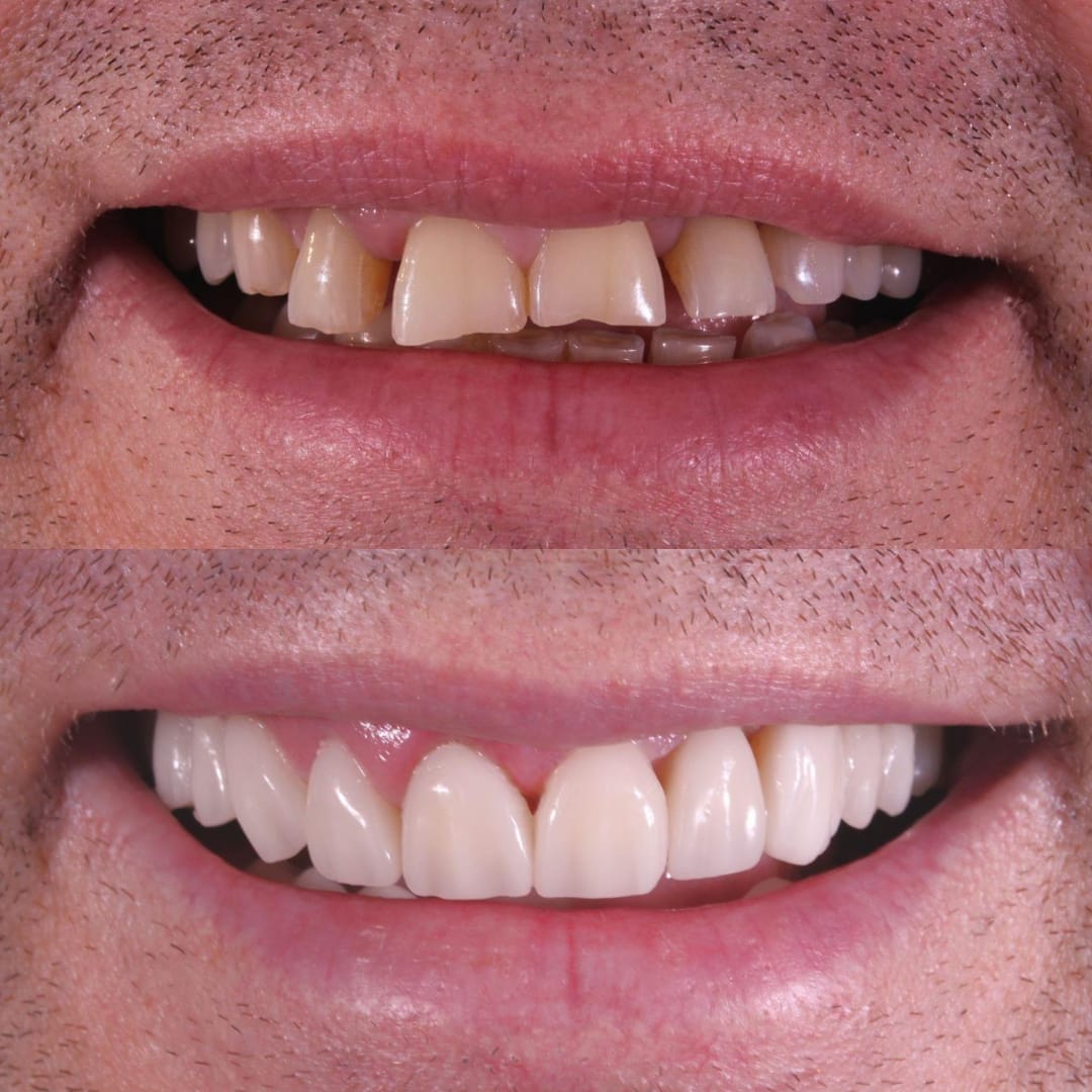Labios antes y después diseño de sonrisa con carillas cerámicas por plano quebrado — AM Estética Dental Puerto Madero