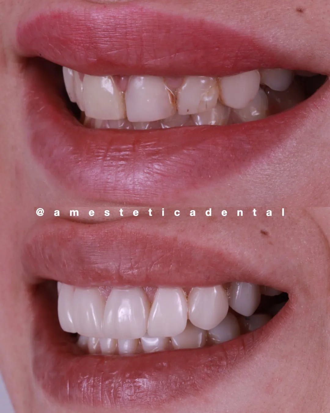 Transformación de sonrisa con carillas cerámicas sobre caries — AM Estética Dental Buenos Aires
