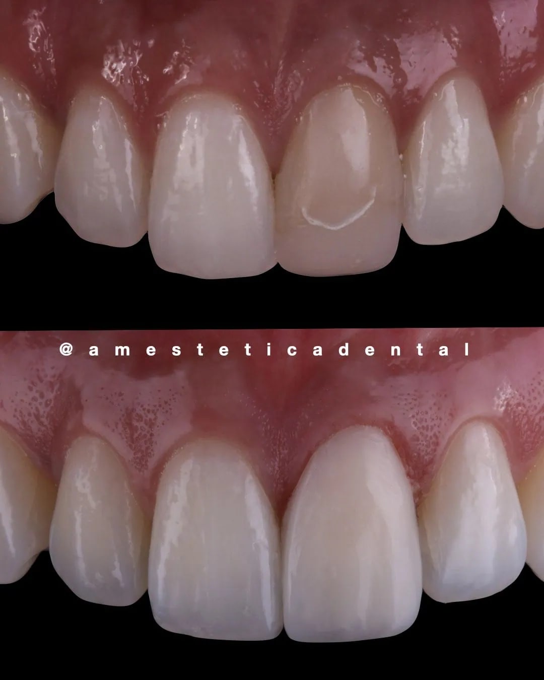 Diente oscurecido tras una endodoncia, resuelto con una carilla — AM Estética Dental