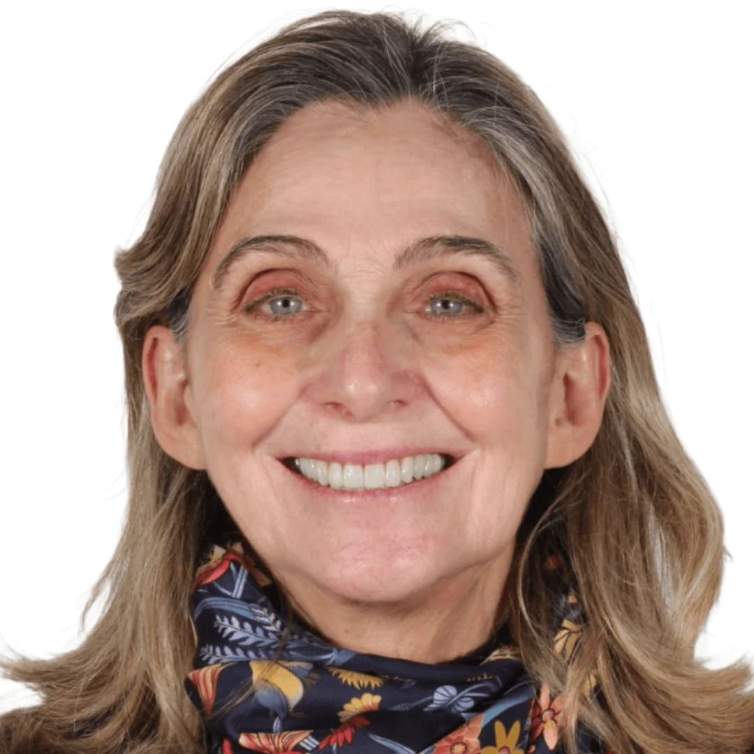 Antes y después carillas cerámicas — AM Estética Dental Buenos Aires