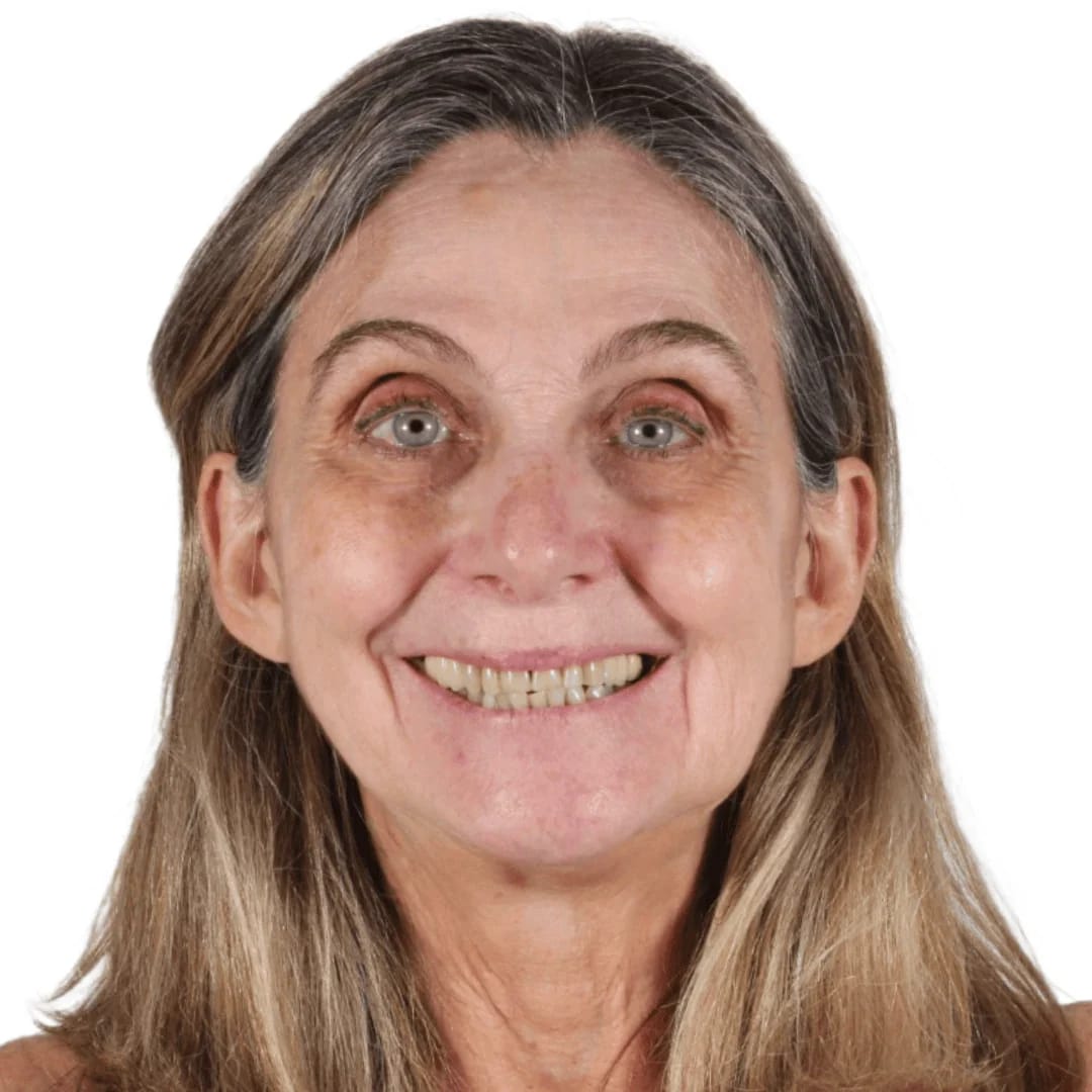 Antes y después carillas cerámicas — AM Estética Dental Buenos Aires