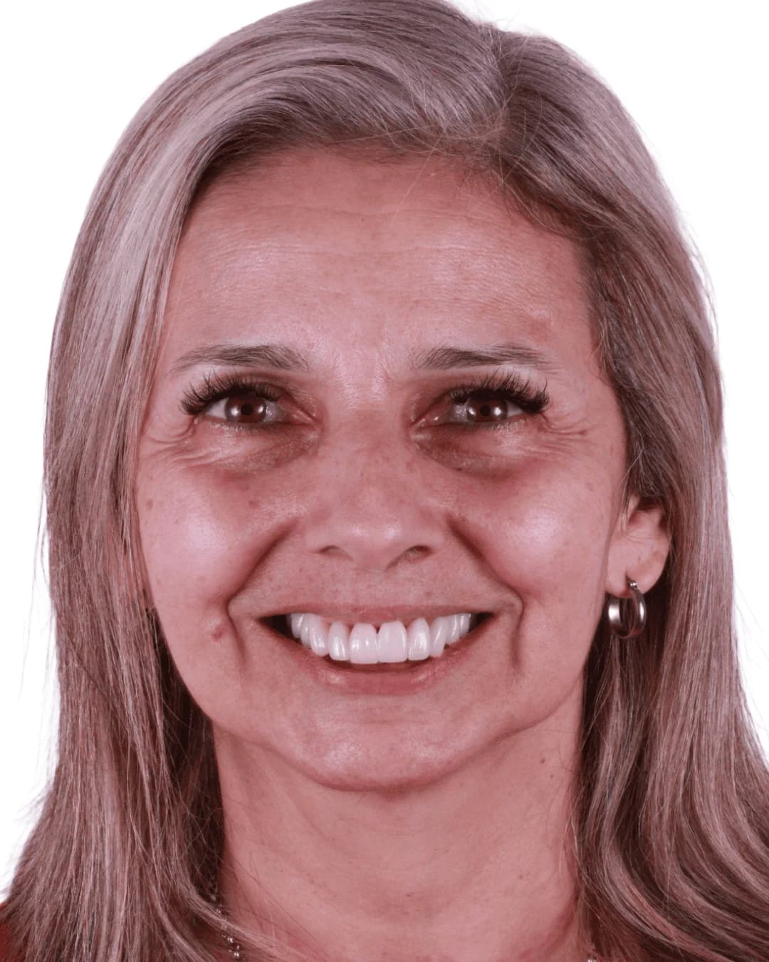Antes y después carillas cerámicas — caso 03 — AM Estética Dental Buenos Aires