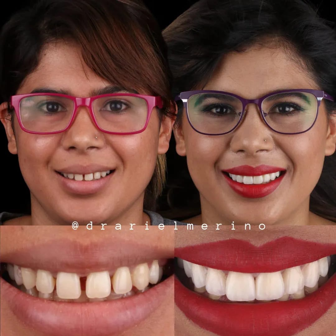 Caso Eli — carillas cerámicas — AM Estética Dental Buenos Aires